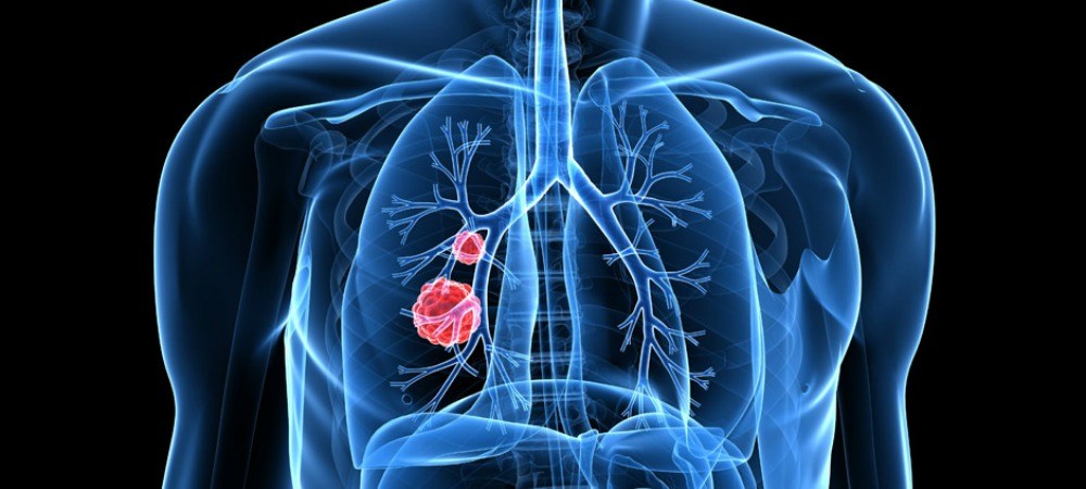 Get Access to New Lung Cancer Treatments