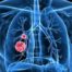 New Lung Cancer Treatments
