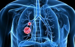 New Lung Cancer Treatments